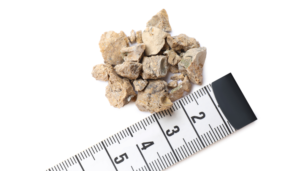 Proses Terbentuknya Batu Ginjal dan Cara Menghancurkannya