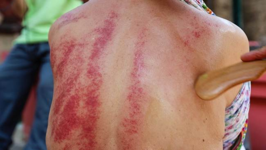 Kerokan: Manfaat, Risiko, dan Fakta Medis di Baliknya