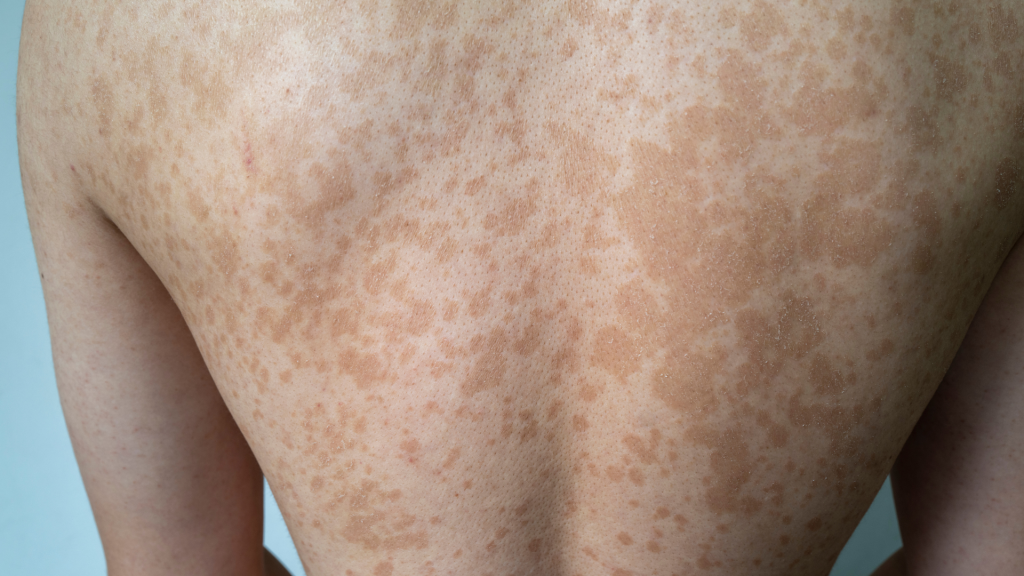 Apa Itu Panu? Kenali Penyebab dan Gejalanya Sejak Dini