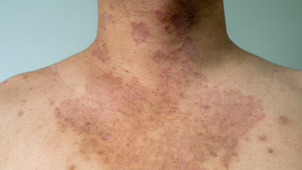 Cara Menghilangkan Panu dengan Bahan Alami dan Obat Medis