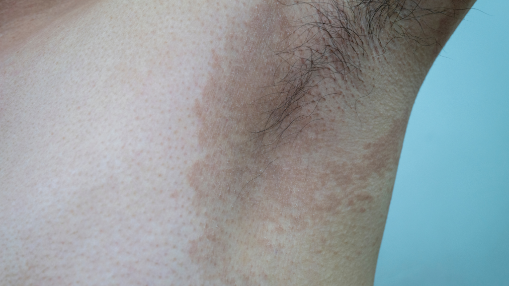 Benarkah Panu Menular? Ini Penjelasan Dokter Kulit