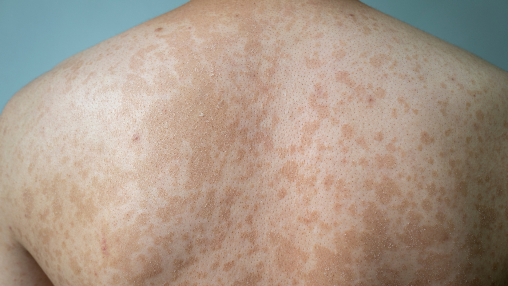 Panu Sering Muncul di Punggung dan Leher? Ini Faktor Pemicunya