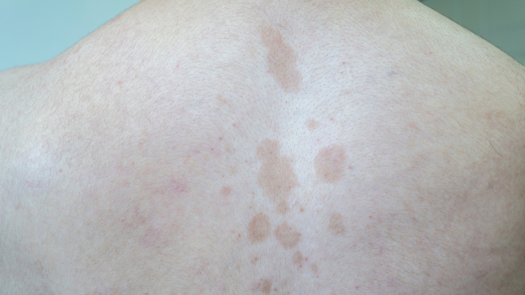 Anak-anak Rentan Terkena Panu? Ini Cara Penanganan Aman