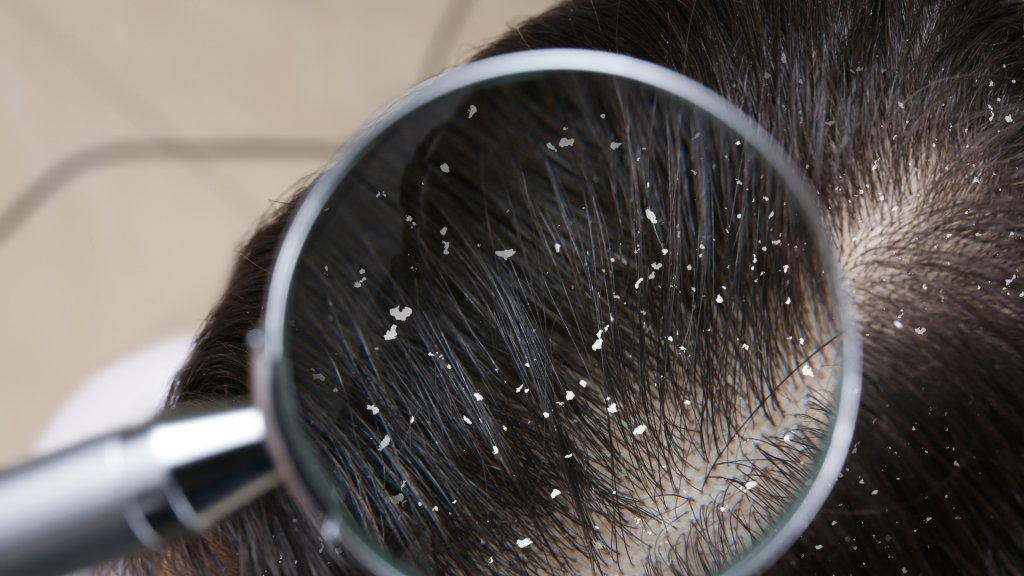 Ketombe Membandel? Kenali Penyebab dan Cara Efektif Mengatasinya