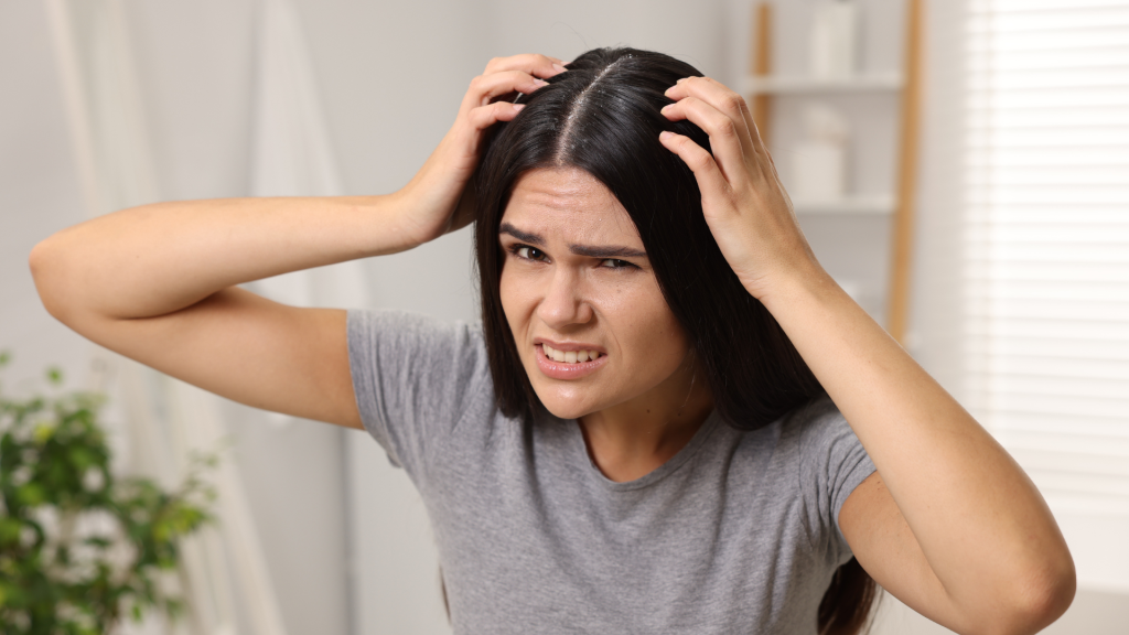 Stres Bisa Sebabkan Ketombe? Ini Penjelasan Medisnya