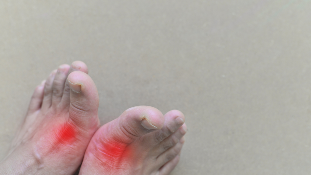 Faktor Risiko Penyakit Asam Urat: Gaya Hidup dan Makanan yang Harus Dihindari