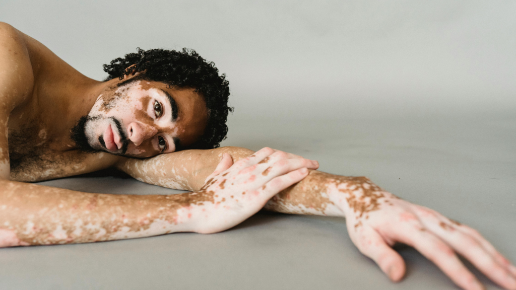 Fakta Imun Autoimun: Ketika Sistem Kekebalan Tubuh Menyerang Diri Sendiri