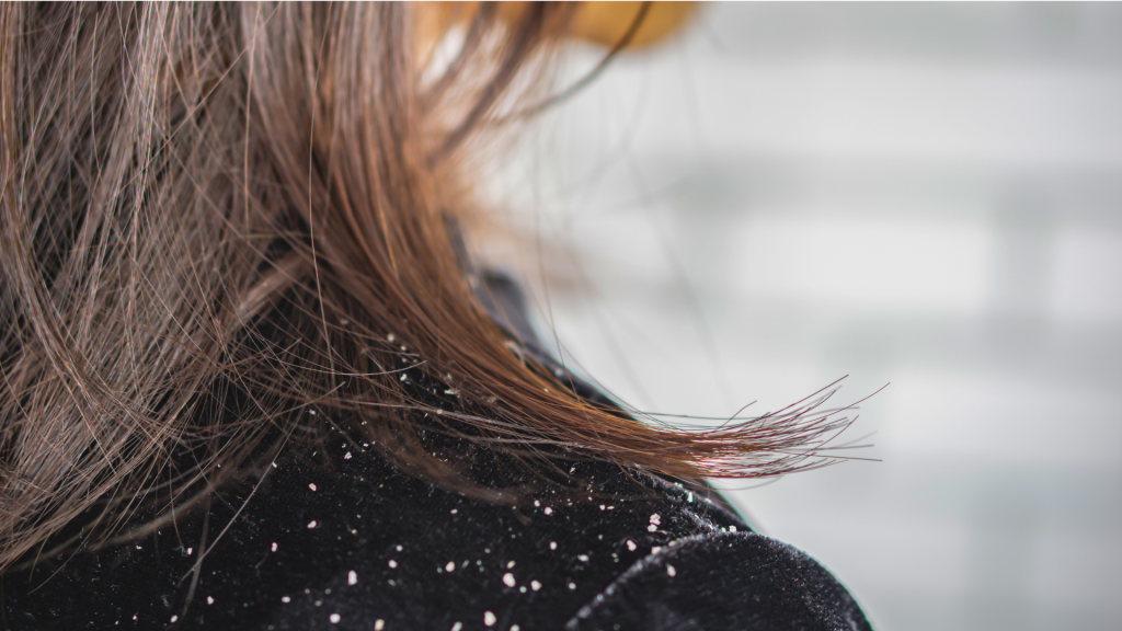 Ketombe pada Anak: Apakah Normal dan Bagaimana Mengatasinya?