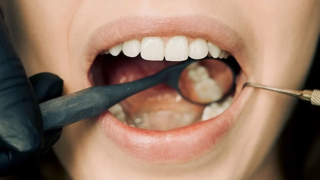 Cara Merawat Gusi agar Tidak Mudah Berdarah