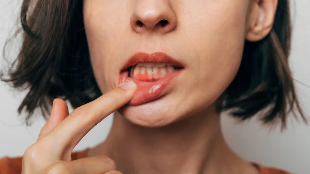 Kekurangan Vitamin dan Pengaruhnya pada Gusi Berdarah