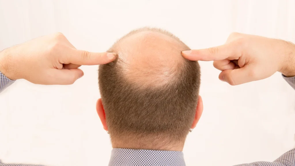 Kebotakan dini adalah kondisi kerontokan rambut yang terjadi lebih awal dari usia umum, biasanya sebelum usia 30 tahun. Meski sering dikaitkan dengan pria, kebotakan dini juga bisa terjadi pada wanita dan membawa dampak psikologis yang cukup besar. Faktor Genetik Sebagai Penyebab Utama Penyebab paling umum dari kebotakan dini adalah faktor keturunan. Jika orang tua atau kakek-nenek mengalami pola kebotakan serupa, kemungkinan besar gen tersebut akan diturunkan dan memicu kebotakan lebih awal. Ketidakseimbangan Hormon Perubahan hormon, terutama hormon androgen seperti DHT (dihydrotestosterone), sangat berperan dalam menyusutkan folikel rambut. Hormon ini bisa membuat rambut tumbuh lebih tipis, pendek, dan akhirnya berhenti tumbuh. Stres dan Gaya Hidup Modern Tingginya tekanan kerja, kurang tidur, dan pola makan yang tidak sehat bisa mempercepat proses kebotakan. Stres berkepanjangan menyebabkan tubuh memproduksi kortisol berlebihan yang memicu kerontokan rambut secara signifikan. Penyakit Autoimun dan Kondisi Medis Beberapa kondisi seperti alopecia areata, lupus, dan gangguan tiroid dapat menyebabkan kerontokan rambut parah. Dalam kasus ini, kebotakan dini bersifat sistemik dan memerlukan penanganan medis yang menyeluruh. Efek Samping Obat-obatan Penggunaan obat tertentu, seperti kemoterapi, obat tekanan darah, atau antidepresan, dapat memengaruhi siklus pertumbuhan rambut. Jika kebotakan terjadi setelah konsumsi obat, konsultasi ke dokter sangat dianjurkan. Pola Makan yang Buruk Rambut membutuhkan nutrisi seperti protein, zat besi, vitamin D, dan biotin untuk tumbuh sehat. Kekurangan nutrisi tertentu bisa melemahkan akar rambut dan menyebabkan kerontokan dalam waktu singkat. Gaya Rambut yang Merusak Pemakaian alat panas, pewarnaan berlebihan, atau mengikat rambut terlalu kencang bisa merusak folikel rambut. Jika dilakukan terus-menerus, kerusakan ini dapat bersifat permanen dan menyebabkan kebotakan dini. Pengaruh Merokok dan Alkohol Kebiasaan merokok dan konsumsi alkohol berlebihan mengganggu sirkulasi darah ke kulit kepala. Folikel rambut yang kekurangan oksigen dan nutrisi akan berhenti memproduksi rambut sehat dan akhirnya mati. Deteksi Dini Sangat Penting Mengamati pola kerontokan rambut sejak awal sangat penting. Jika rambut mulai menipis di bagian dahi, tengah kepala, atau mengalami penurunan garis rambut secara cepat, segera periksa ke dokter kulit atau spesialis rambut. Perawatan Medis: Minoxidil dan Finasteride Minoxidil (obat topikal) dan finasteride (obat oral) adalah dua pengobatan umum untuk kebotakan. Keduanya bekerja dengan menstimulasi folikel rambut dan menghambat produksi DHT. Hasilnya butuh waktu dan pemakaian rutin. Terapi PRP dan Laser Platelet-Rich Plasma (PRP) dan terapi laser adalah metode modern yang menjanjikan. PRP memanfaatkan darah pasien sendiri untuk menstimulasi pertumbuhan rambut, sementara laser membantu memperbaiki sirkulasi darah di kulit kepala. Transplantasi Rambut Sebagai Solusi Permanen Jika kebotakan sudah luas dan tidak merespons obat, transplantasi rambut bisa menjadi pilihan. Prosedur ini memindahkan folikel rambut sehat ke area botak, memberikan hasil alami jika dilakukan oleh ahli berpengalaman. Dukungan Psikologis Tidak Boleh Diabaikan Kebotakan dini sering berdampak pada kepercayaan diri dan kesehatan mental. Konseling atau dukungan dari komunitas bisa membantu individu menghadapi perubahan ini dengan lebih positif. Kesimpulan: Cegah Sejak Dini, Tangani dengan Bijak Kebotakan dini bisa dicegah dan dikendalikan jika ditangani sejak awal. Mengenali penyebabnya, mengubah gaya hidup, serta berkonsultasi dengan ahli akan membantu menjaga rambut tetap sehat dan mencegah kerontokan lebih parah.