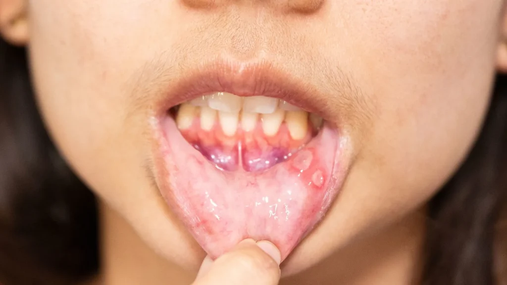 Tips Mencegah Sariawan Kambuh Berulang