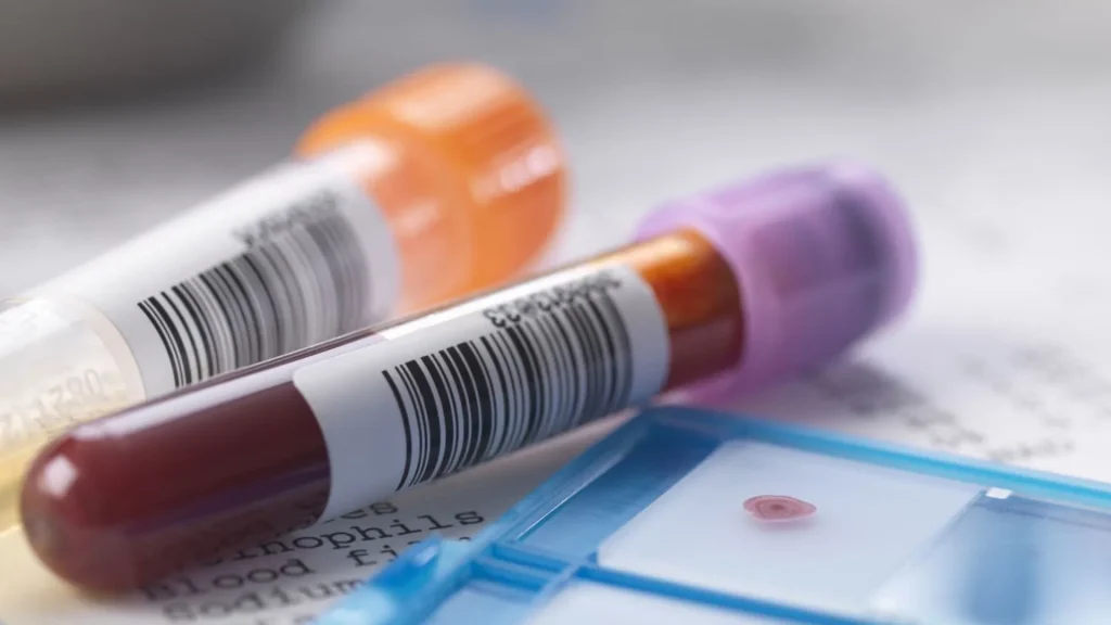 Pemeriksaan sel CD4 sangat penting untuk mengevaluasi sistem imun pasien HIV.