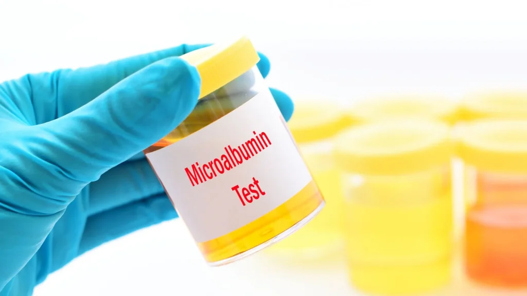 Microalbumin test kit adalah alat uji sederhana yang bisa membantu mendeteksi kebocoran albumin pada urin, sebagai tanda awal gangguan ginjal.