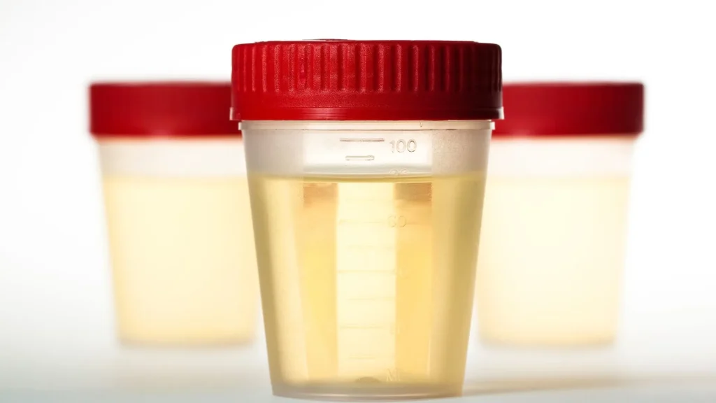 Dalam dunia medis, pemeriksaan urin menjadi salah satu metode paling sering dilakukan.
