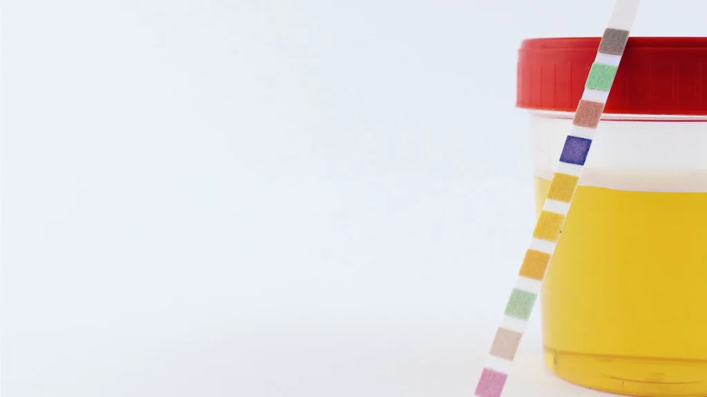 Skala “Trace” hingga “+4” adalah cara umum untuk menunjukkan kadar protein dalam urin berdasarkan hasil test strip.