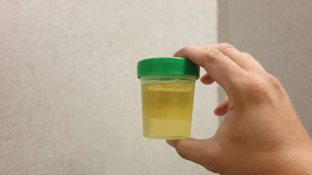 Tes urin 24 jam menjadi salah satu metode diagnostik penting untuk mengevaluasi kondisi ginjal, sistem hormonal, serta metabolisme tubuh secara menyeluruh.