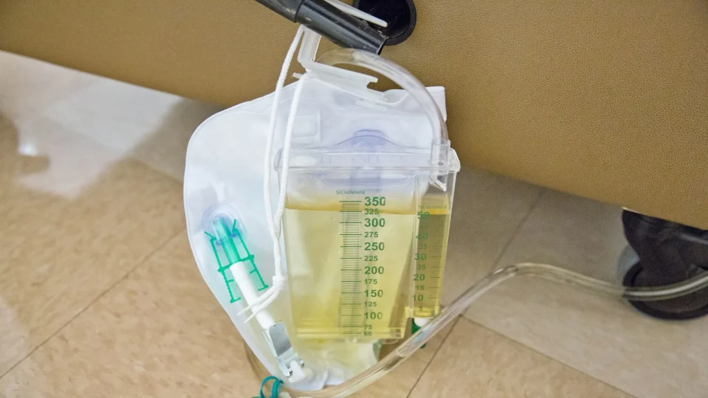 Urine flow meter adalah alat diagnostik noninvasif yang digunakan untuk mengukur kecepatan dan volume aliran urin saat buang air kecil.