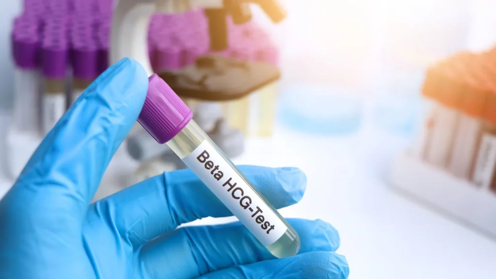 Beta-hCG Urine ELISA adalah metode laboratorium yang digunakan untuk mendeteksi keberadaan hormon human chorionic gonadotropin (hCG) dalam urin.