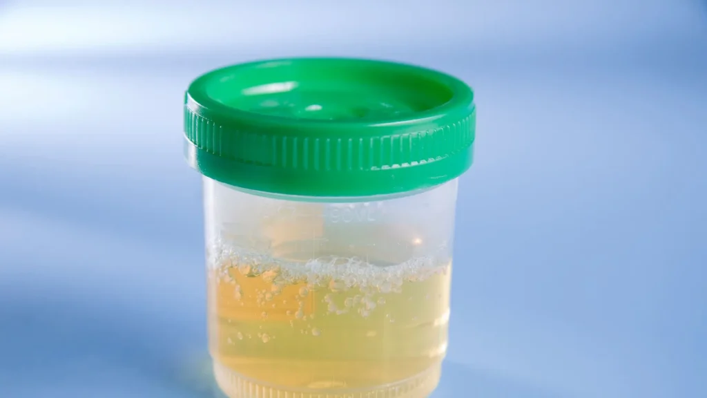 Beta-hCG Urine ELISA merupakan metode laboratorium yang memiliki tingkat sensitivitas tinggi dalam mendeteksi hormon human chorionic gonadotropin (hCG) di urin.