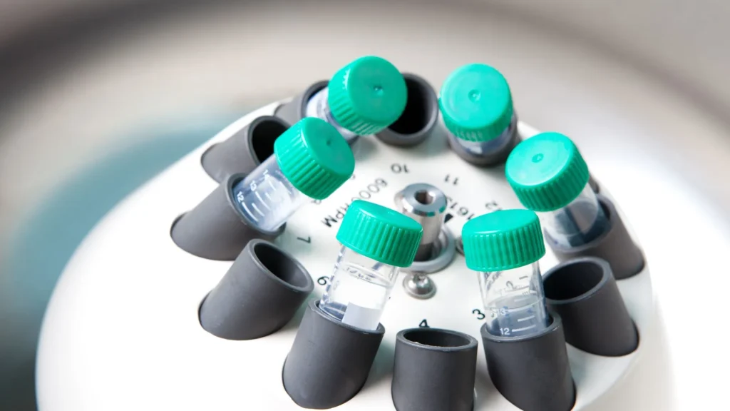 Urinalisis merupakan salah satu pemeriksaan laboratorium yang penting dalam dunia medis, terutama untuk mendeteksi penyakit ginjal, infeksi saluran kemih, hingga gangguan metabolik.