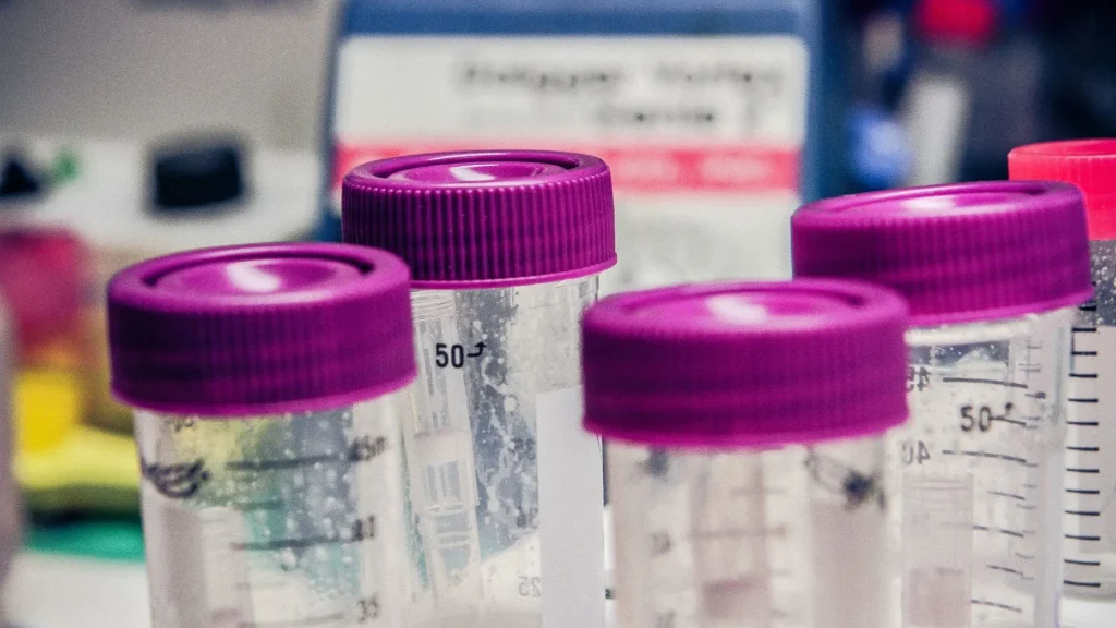 Urinalisis mikroskopis merupakan prosedur penting dalam dunia medis, dan keberhasilan pemeriksaan sangat bergantung pada ketelitian saat menyiapkan sampel.