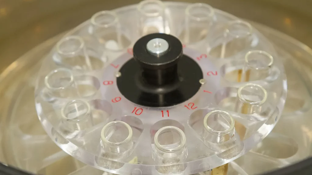 Pemrosesan urin dengan centrifuge tube merupakan tahap penting dalam analisis sedimen urin.