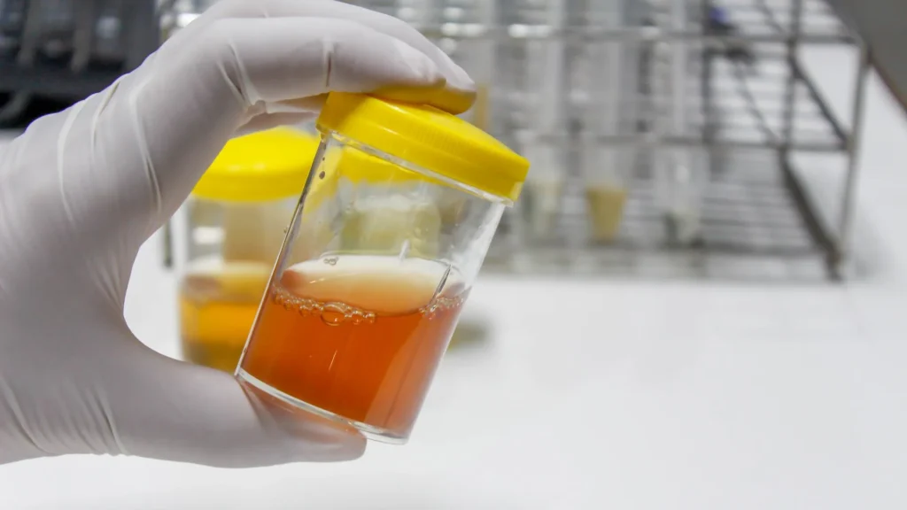 Sampel urin merupakan bahan pemeriksaan yang sensitif terhadap degradasi seluler dan mikrobiologis.