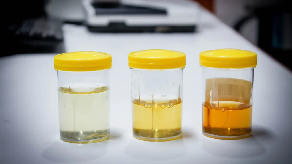 Sitologi urin merupakan pemeriksaan penting dalam mendeteksi kelainan seluler pada saluran kemih, termasuk infeksi hingga kanker.