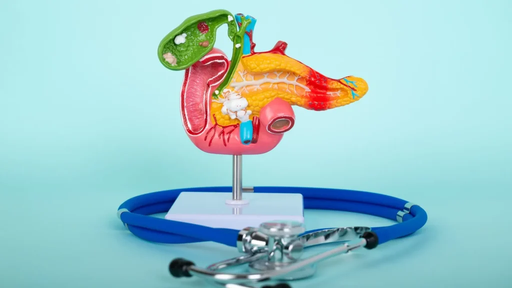 Batu empedu bisa menimbulkan gejala ringan hingga berat.