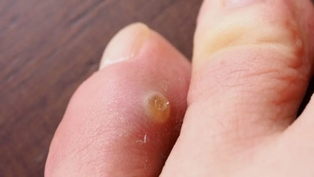 Mata ikan atau clavus adalah kondisi kulit berupa penebalan kecil yang biasanya muncul pada kaki atau jari.