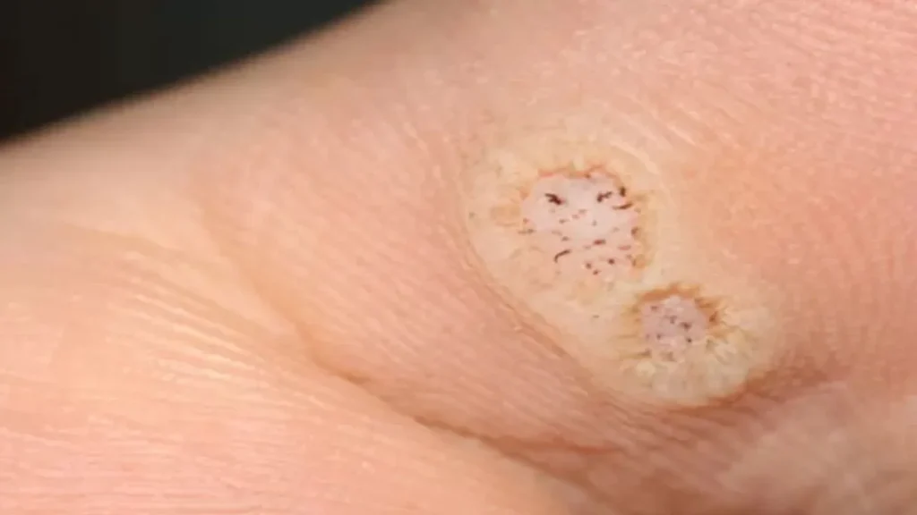 Mata ikan dapat menimbulkan rasa tidak nyaman, terutama saat berjalan.