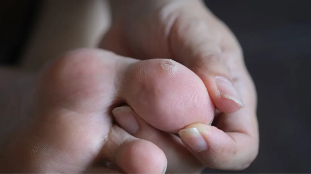 Mata ikan adalah penebalan kulit kecil yang sering muncul akibat gesekan dan tekanan.