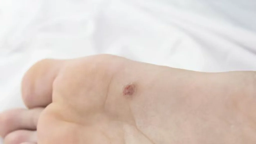 Mata ikan sering muncul akibat gesekan dan tekanan berulang pada kulit kaki.