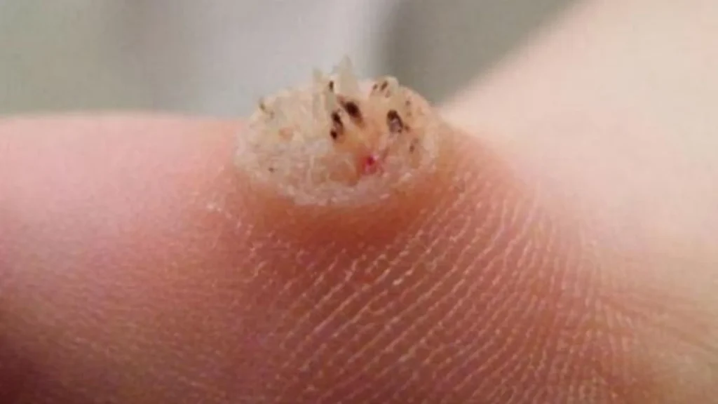 Mata ikan sering dianggap penyakit ringan yang bisa hilang dengan sendirinya.