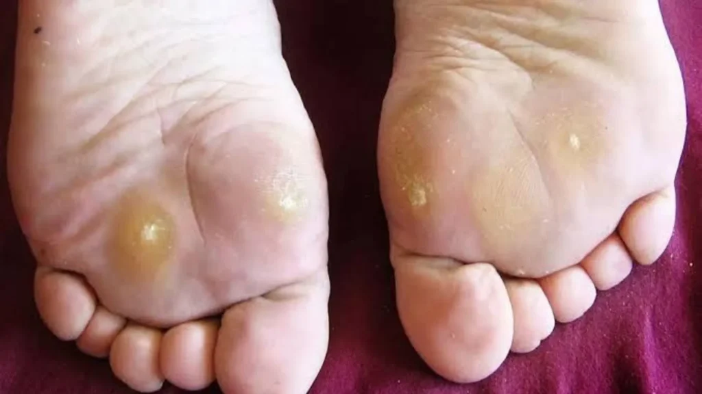 Alas kaki bukan hanya pelindung dari permukaan tanah, tetapi juga berperan besar dalam menjaga kesehatan kulit.