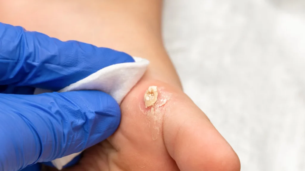 Mata ikan sering dianggap masalah kulit ringan, padahal jika diabaikan bisa menimbulkan komplikasi.