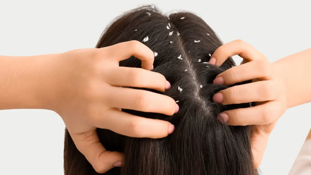 Ketombe adalah masalah kulit kepala yang umum, dan salah satu cara paling praktis untuk mengatasinya adalah dengan menggunakan sampo anti ketombe.