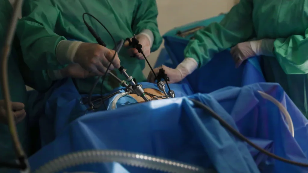 Laparoskopi merupakan teknik bedah minimal invasif yang memungkinkan dokter melakukan operasi dengan sayatan kecil.