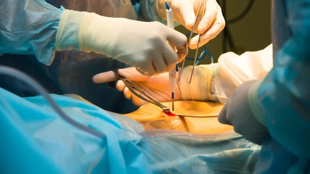 Bedah laparoskopi merupakan salah satu inovasi besar dalam dunia kedokteran modern yang memungkinkan prosedur pembedahan dilakukan tanpa sayatan besar.