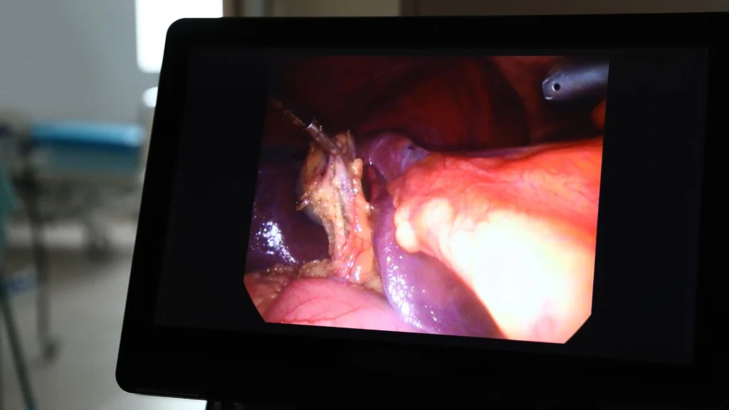 Laparoskopi sering disebut sebagai “operasi lubang kunci” karena prosedurnya dilakukan melalui sayatan yang sangat kecil, menyerupai ukuran lubang kunci.