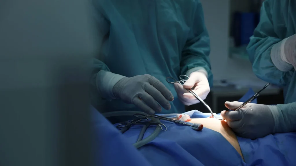 Operasi laparoskopi dilakukan dengan bantuan kamera yang dimasukkan ke dalam tubuh, sehingga pandangan dokter terbatas pada gambar di monitor.