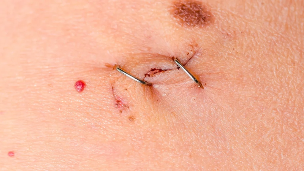 Teknologi robotik telah membawa perubahan besar dalam dunia bedah, termasuk dalam prosedur laparoskopi.