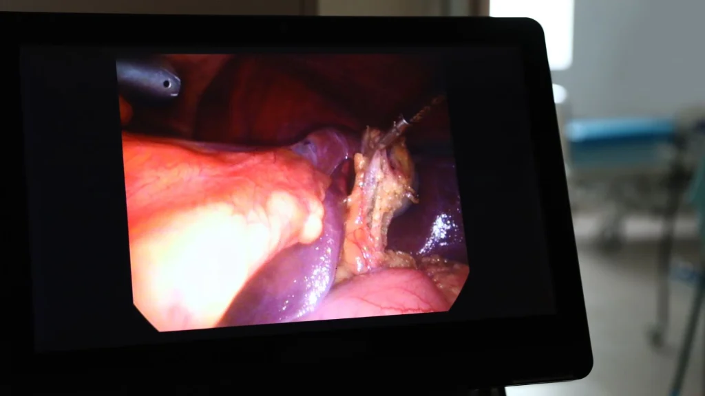 Teknologi high definition (HD) telah menjadi alat penting dalam pendidikan bedah modern, terutama dalam bidang laparoskopi.