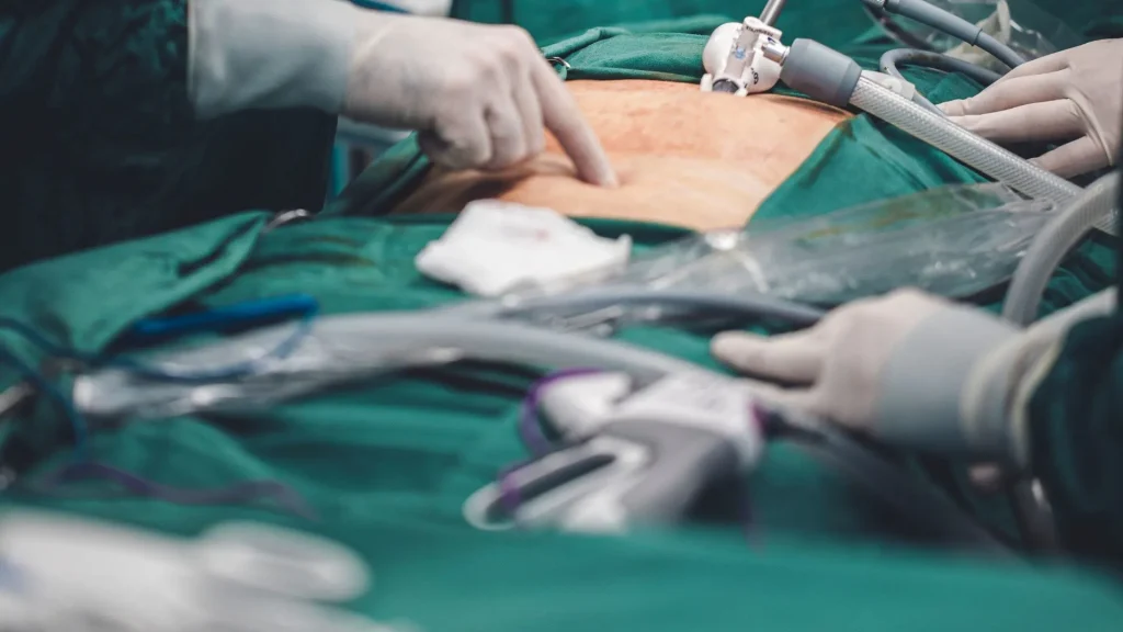 Perpaduan antara laparoskopi dan teknologi robotika telah mengubah paradigma dunia bedah modern.