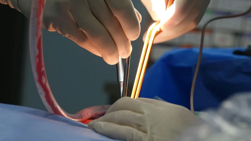 Kerusakan pembuluh darah besar merupakan komplikasi serius yang dapat terjadi selama prosedur bedah, termasuk laparoskopi.