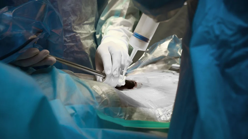 Pencegahan komplikasi dalam prosedur laparoskopi merupakan aspek fundamental untuk menjamin keselamatan pasien dan keberhasilan operasi.