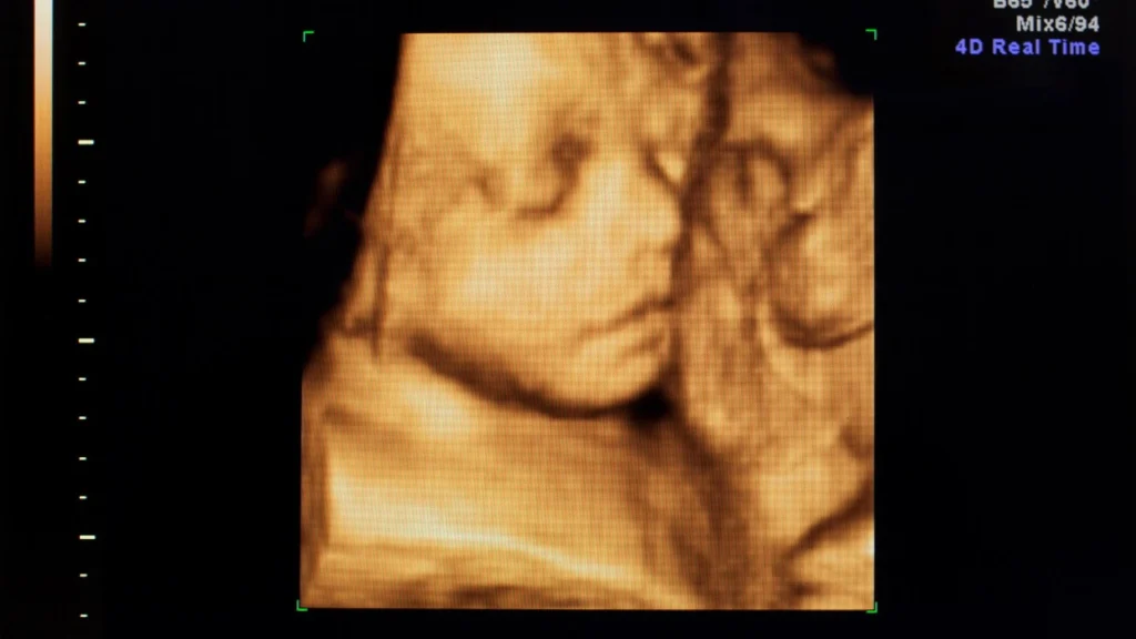 USG 5D menawarkan citra janin dengan resolusi tinggi dan gerakan real-time yang halus, memungkinkan dokter melihat anatomi secara lebih rinci.