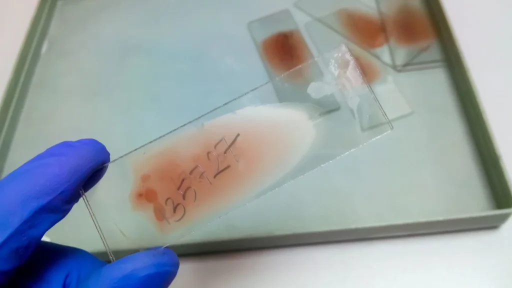 Integrasi kecerdasan buatan dalam analyzer hematologi generasi baru membawa perubahan signifikan dalam kualitas pemeriksaan laboratorium.