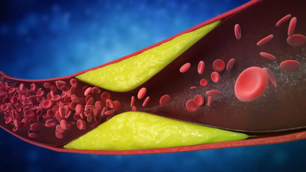 Mengenal Aterosklerosis, Bahaya Penyumbatan Pembuluh Darah